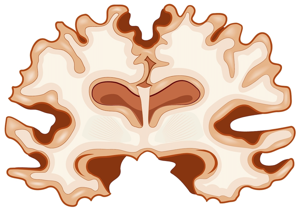 Understanding Alzheimer’s disease and its progression
