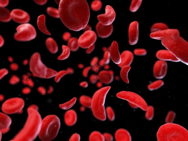 What is sickle cell anemia?