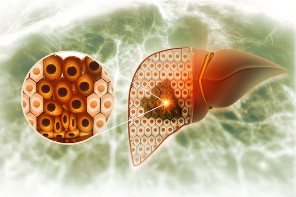 An overview of steatohepatitis