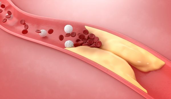 Age-related diseases: hypercholesterolemia