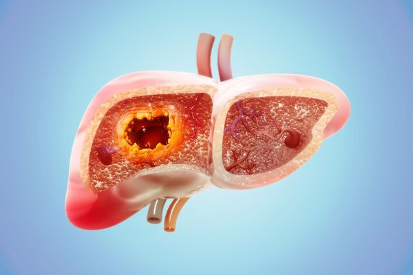 An overview of hepatocellular carcinoma