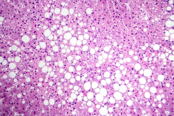 An overview of steatosis