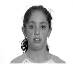 Poor Facial Development