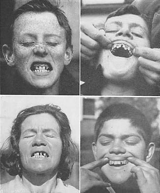 Whites in New Zealand Eating a Modern Diet