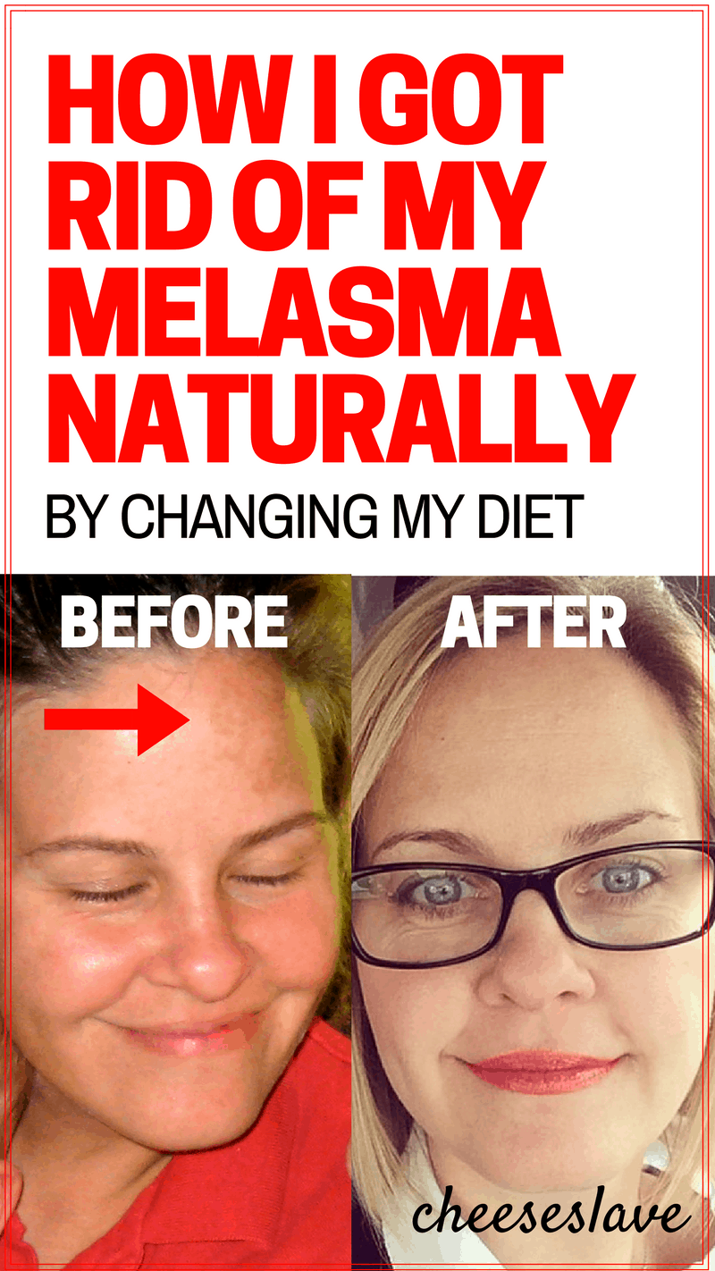How I Got Rid of My Melasma Naturally  