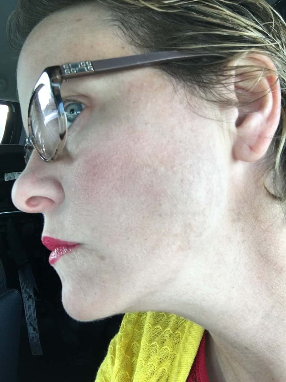 How I Got Rid of My Melasma Naturally