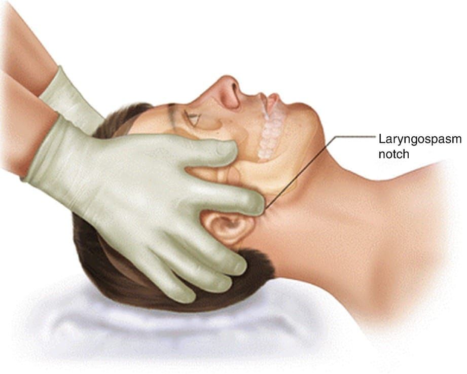 Laryngospasm