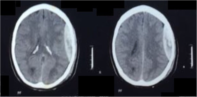 Extradural haematoma