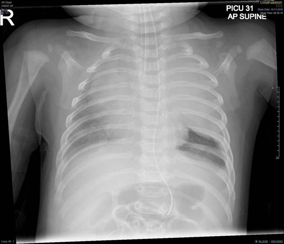 Paediatric Mediastinal Mass