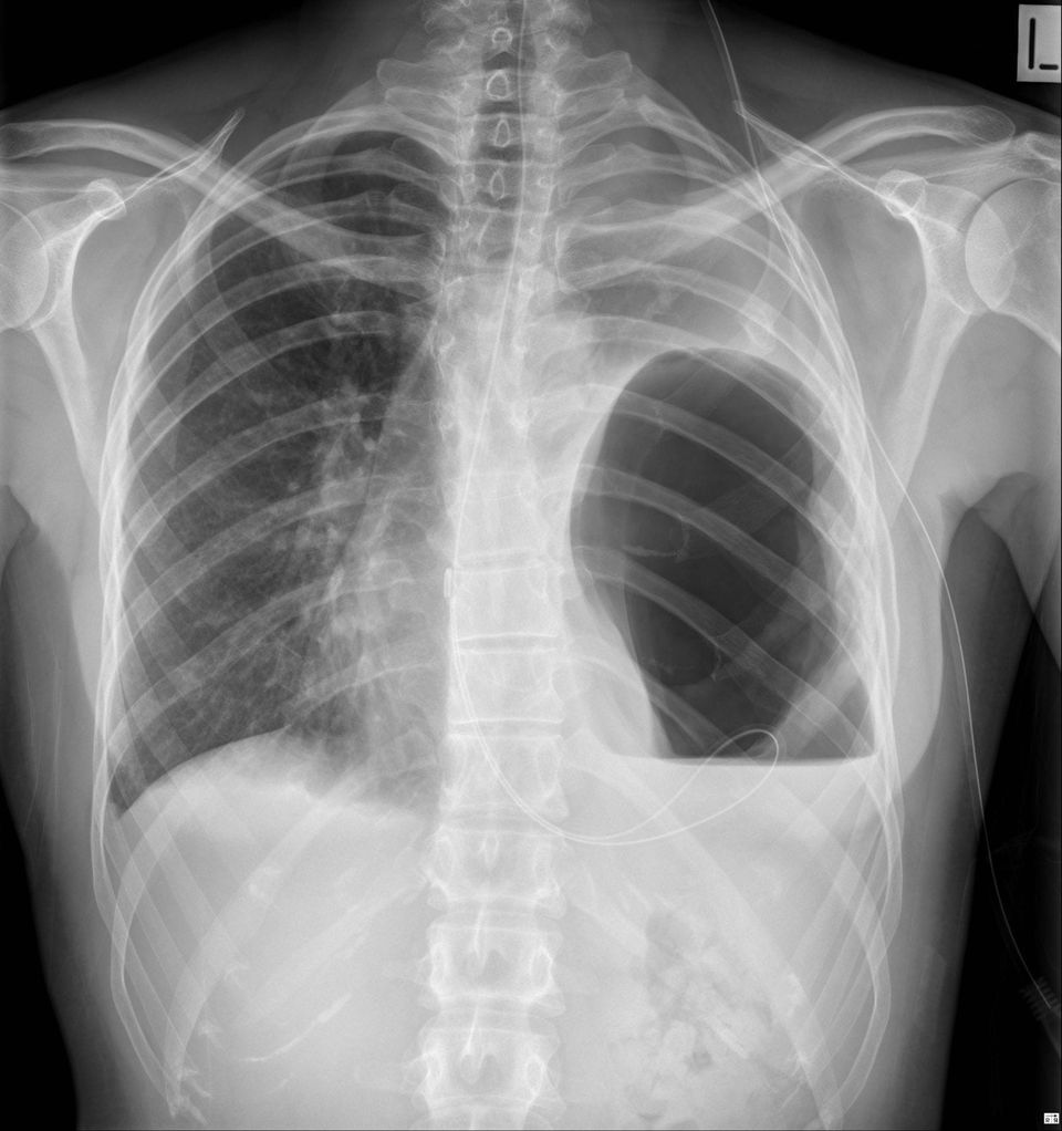 Traumatic Diaphragmatic Hernia