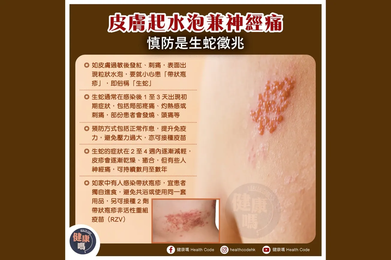 皮膚起水泡兼神經痛 慎防生蛇徵兆