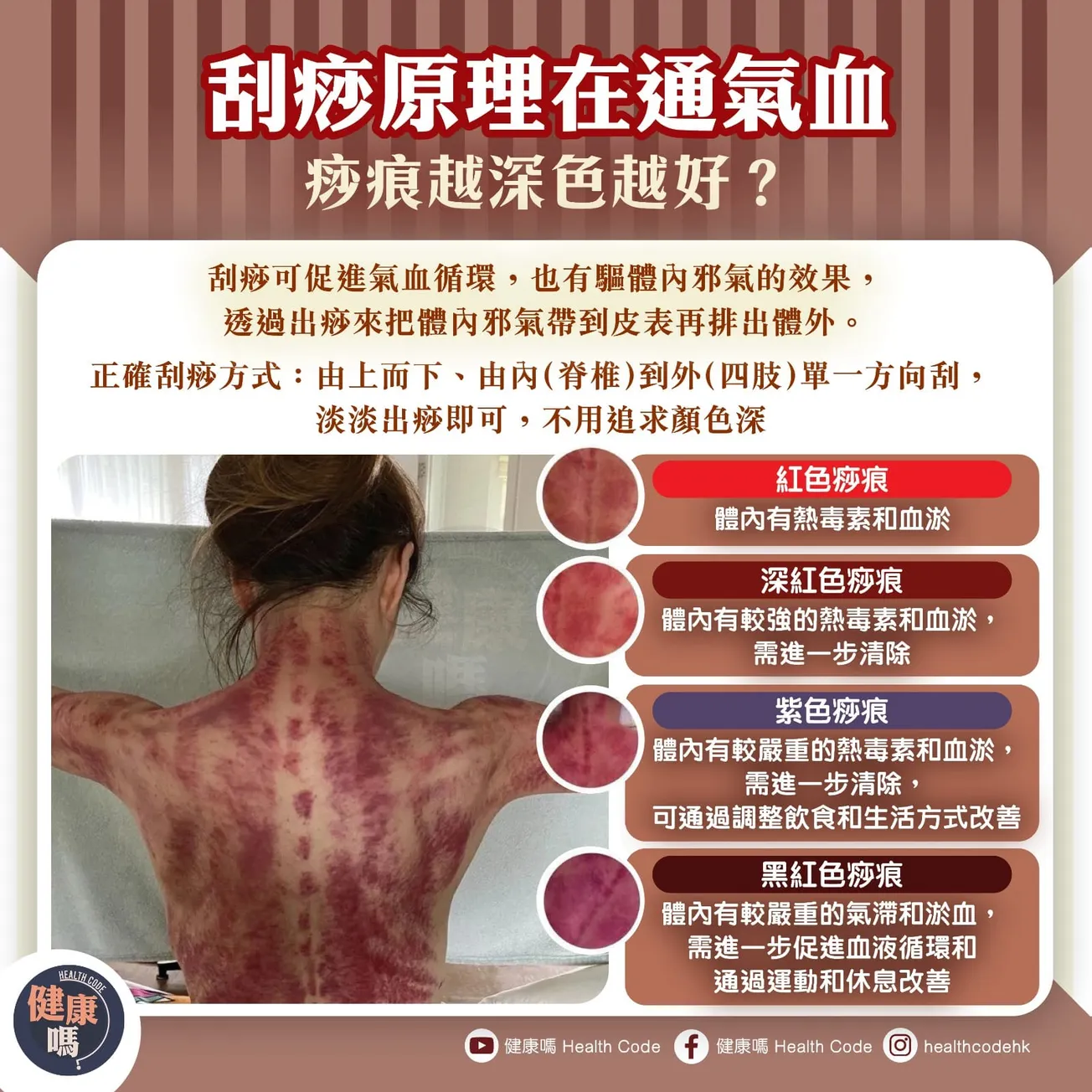 刮痧原理在通氣血 痧痕越深色越好？