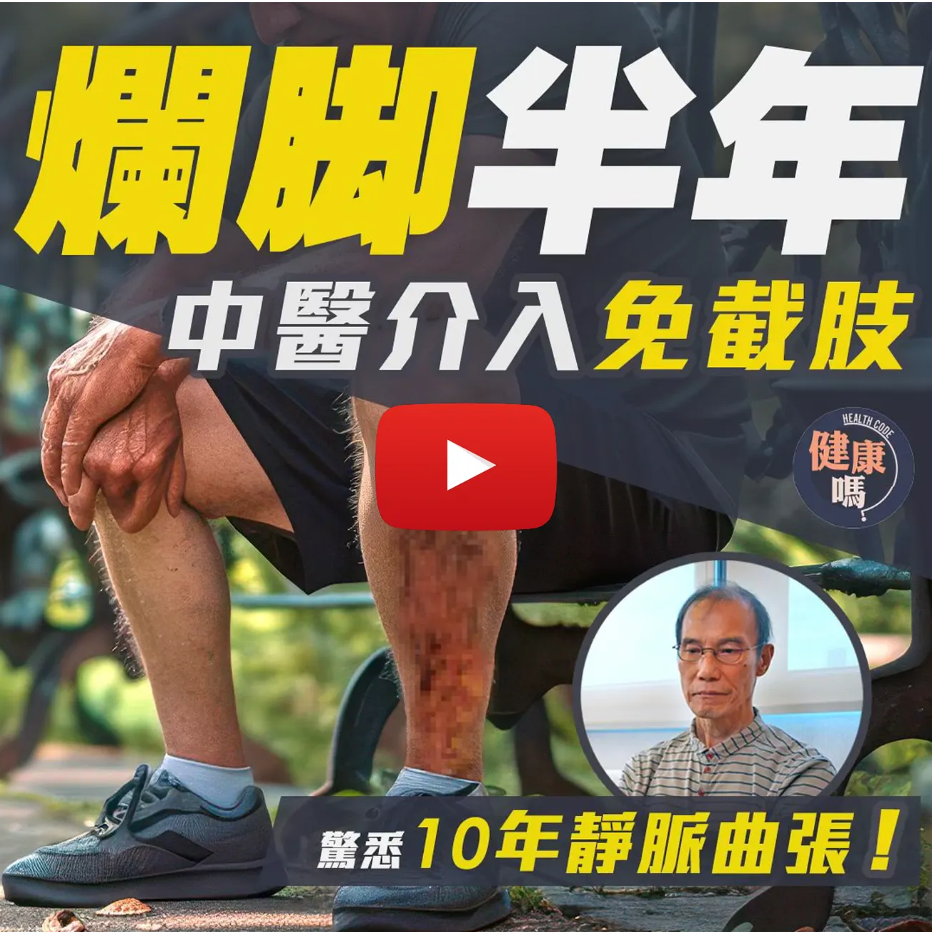 爛腳半年險截肢 10年靜脈曲張懵然不知 中醫介入方痊愈｜正確認識靜脈曲張6階段｜2動作預防舒緩