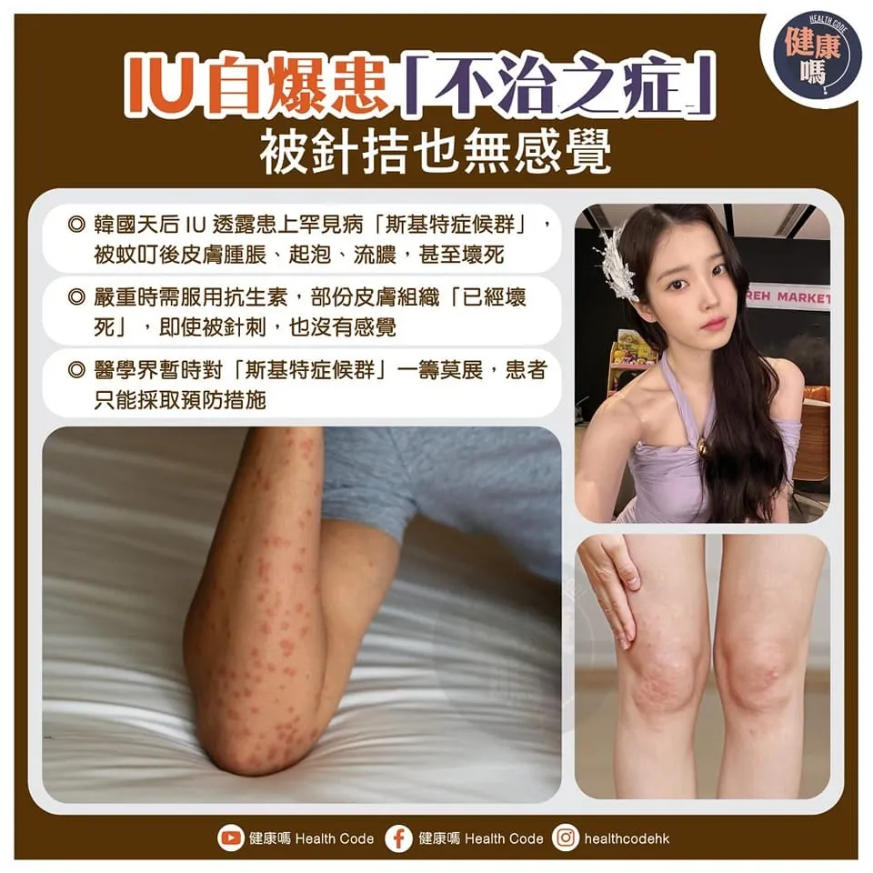 IU 自曝患不治之症 被針拮也無感覺