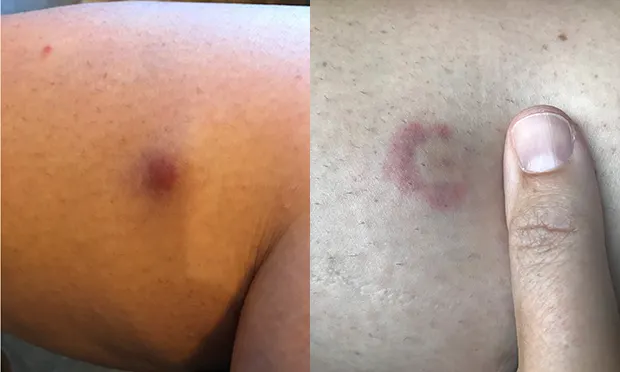 Council to put up warnings about ticks after woman reports catching Lyme disease in Clissold Park