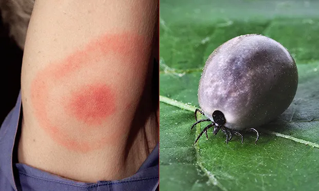 Woman catches Lyme disease from tick bite at Clissold Park, say residents