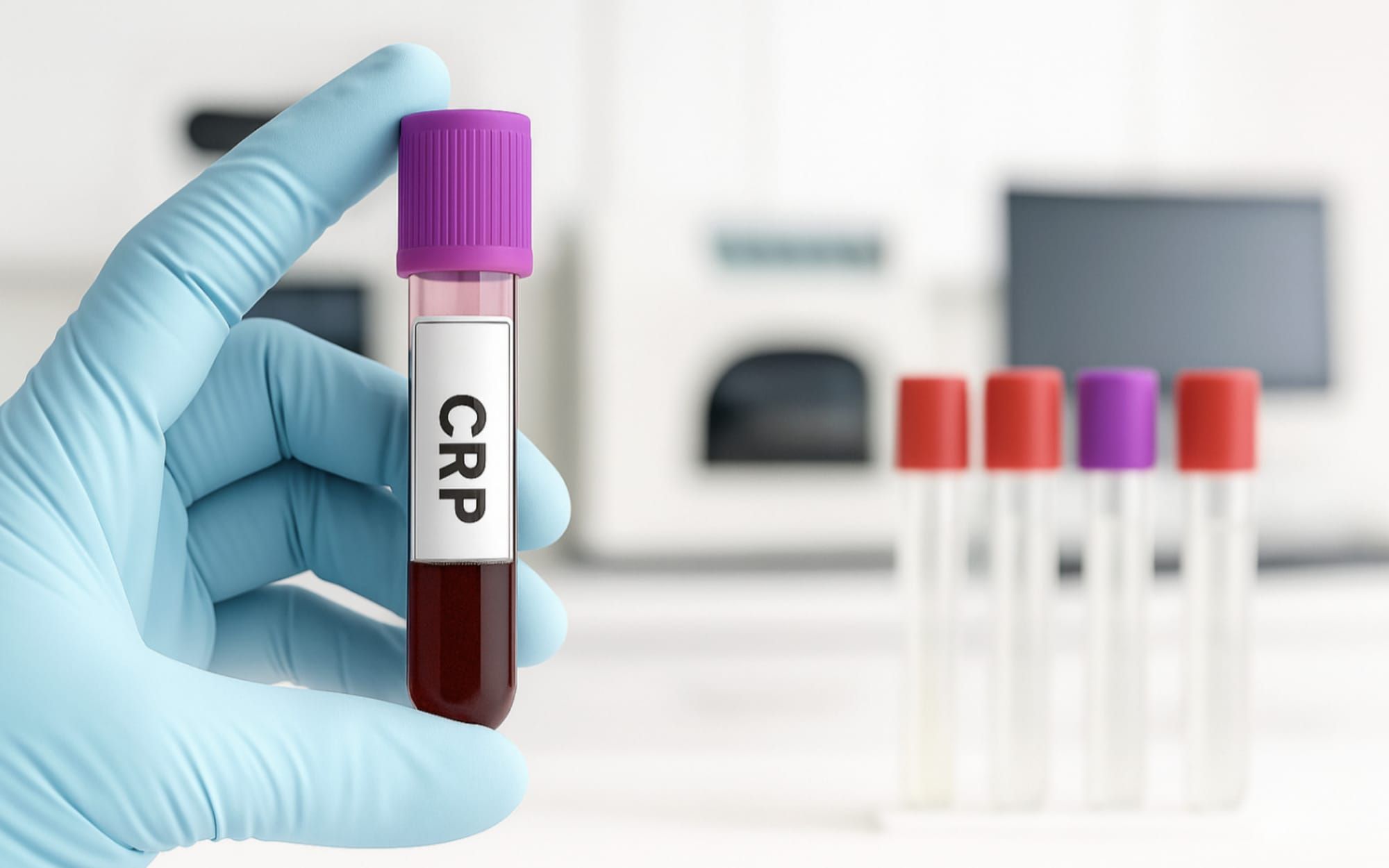 CRP 라고 적힌 튜브를 들고 있는 손