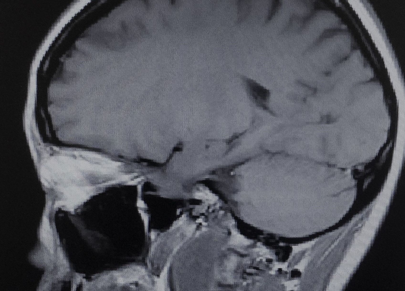 Is surgery best for an acoustic neuroma?
