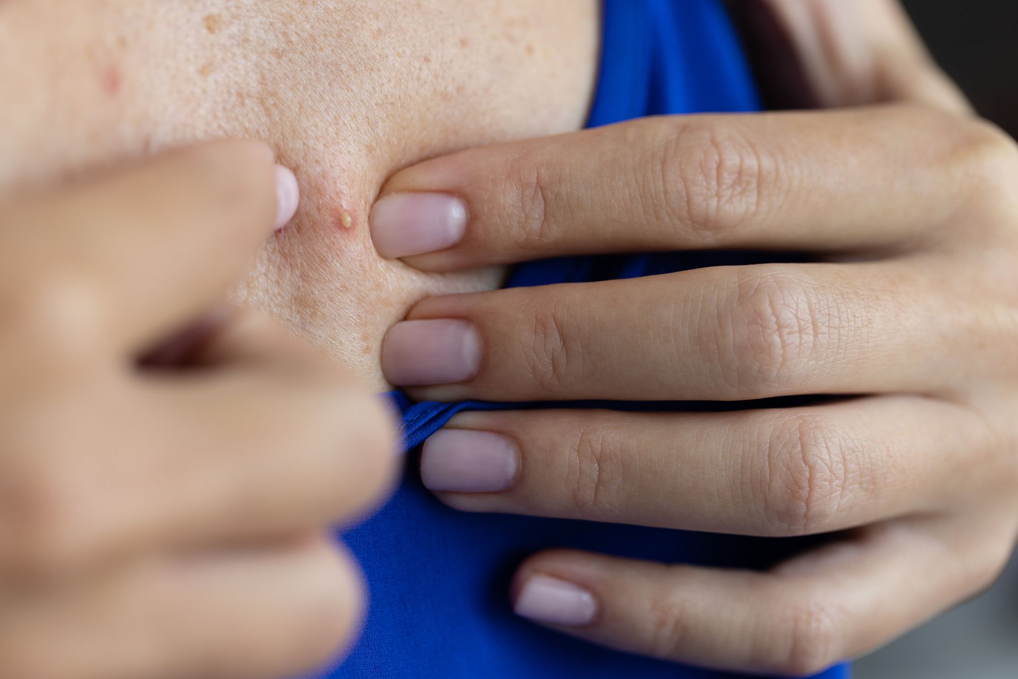 Facts about body acne
