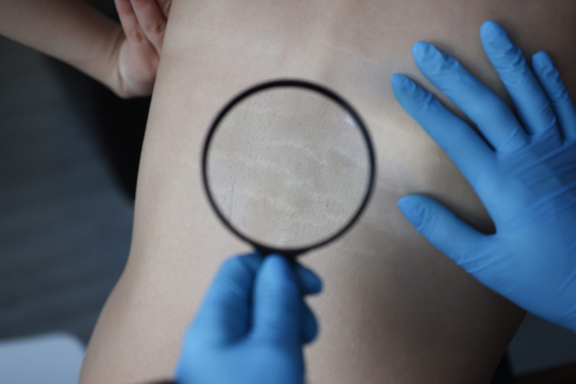 Are stretch marks common during teen years?