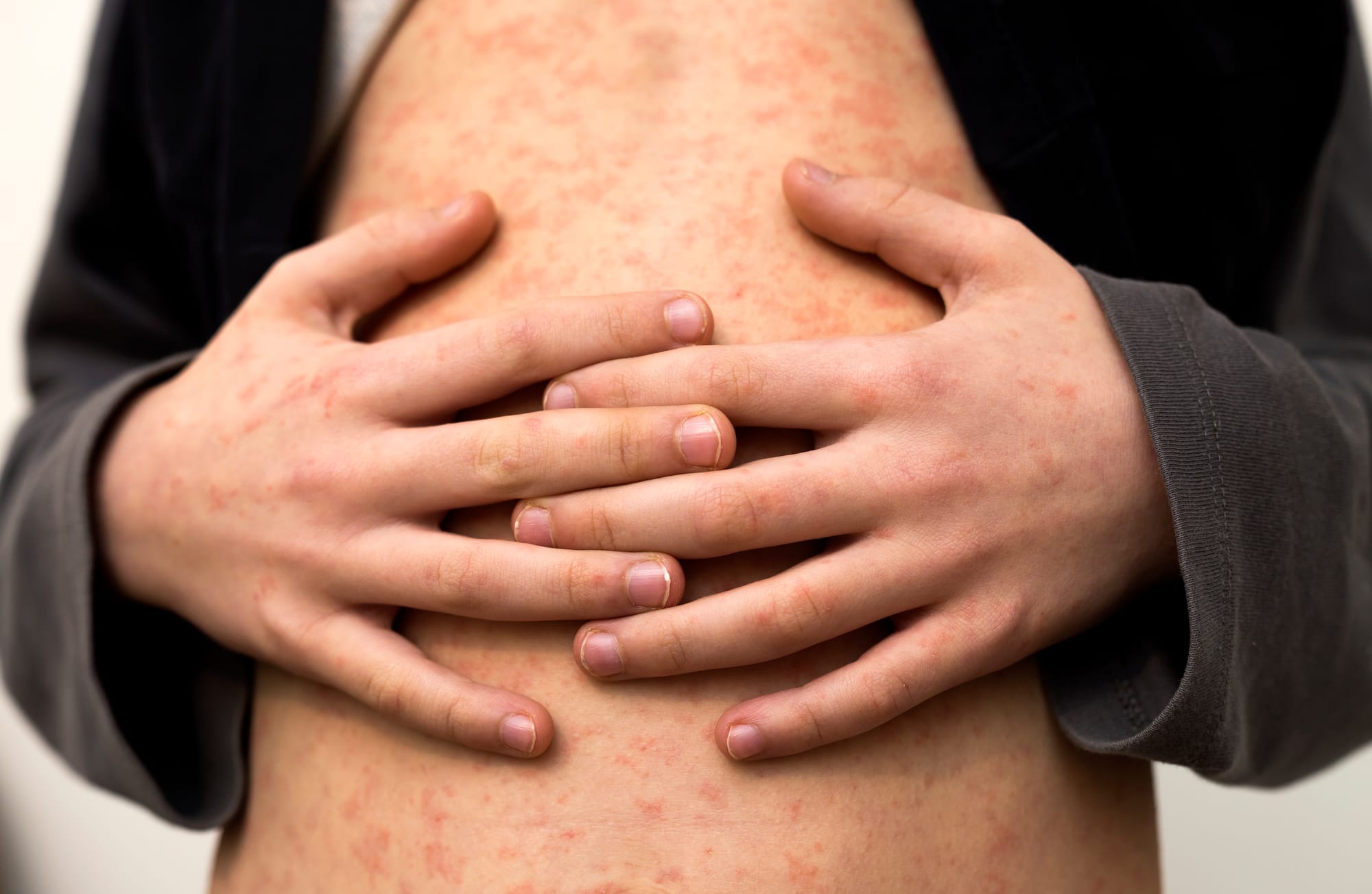 Extra scrutiny of school vaccine records amid measles outbreak