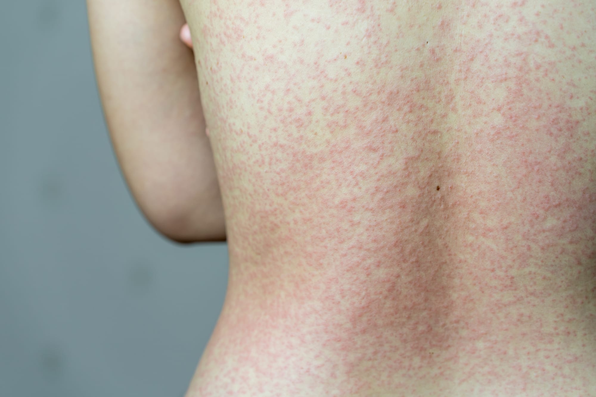 Woolwich sites among latest to see exposure to measles