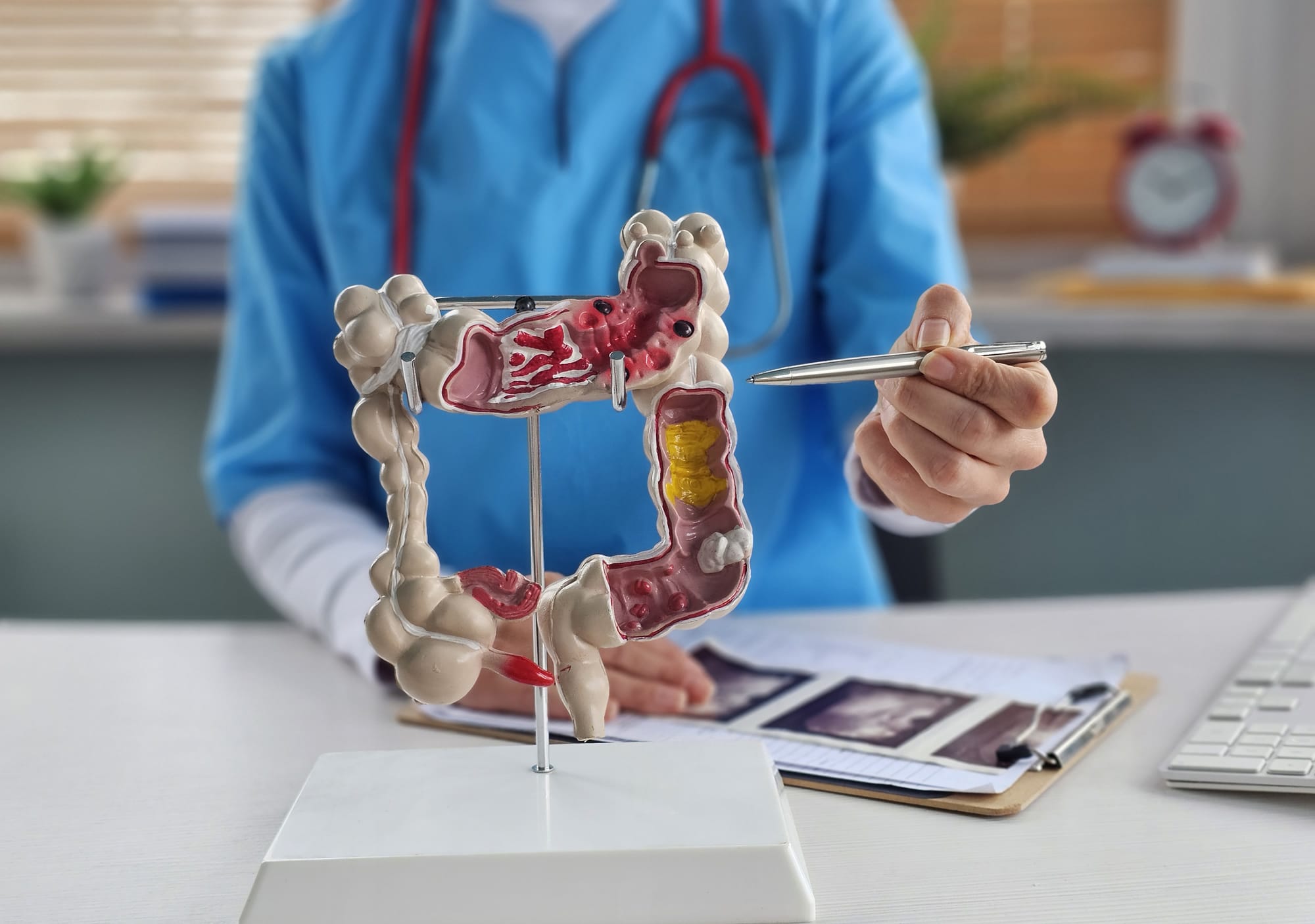 What do you know about colon cancer?