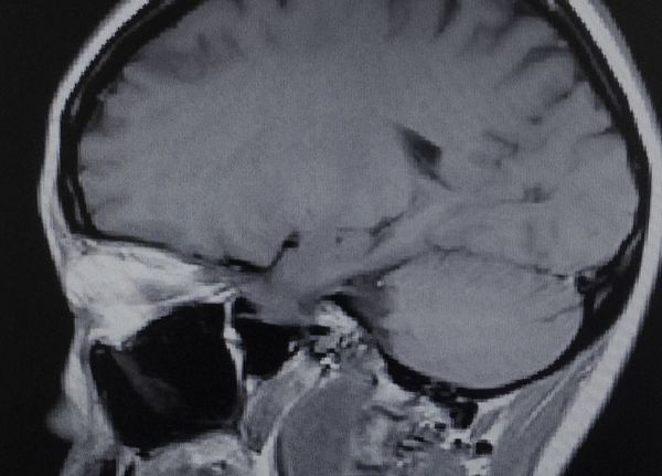 Is surgery best for an acoustic neuroma?