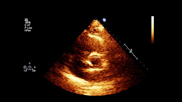 Hole in heart treatment options