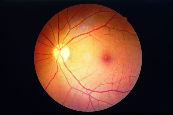 Diabetes and your eyes