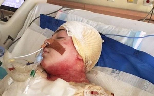 Community rallies in support of teen who suffered burns