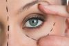 Cat Eye Thread Lift: Say Goodbye to Droopy Eyelids