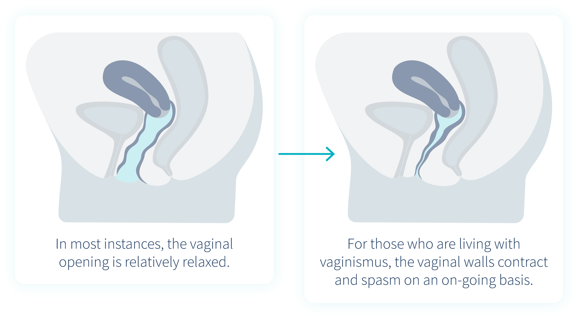 vaginismus-vs-no-vaginismus-1