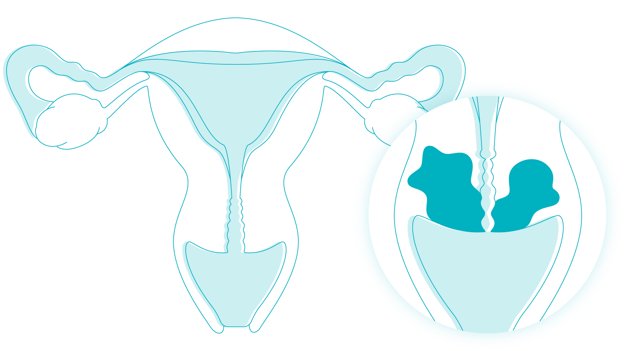 cervitiis-possible-cause-of-yellow-discharge-illustration-