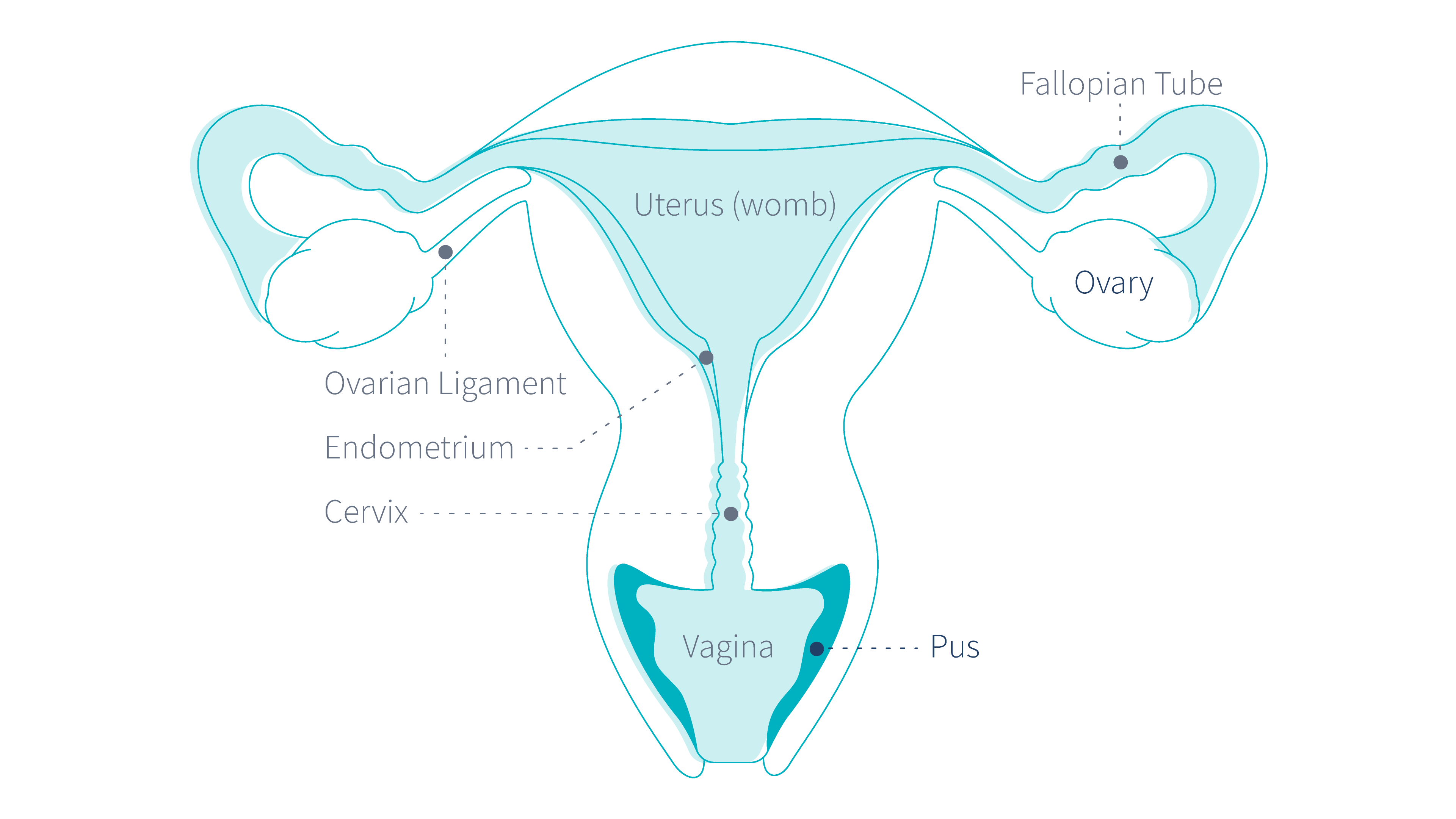 pelvic-inflammatory-disease-possible-cause-of-yellow-vaginal-discharge-