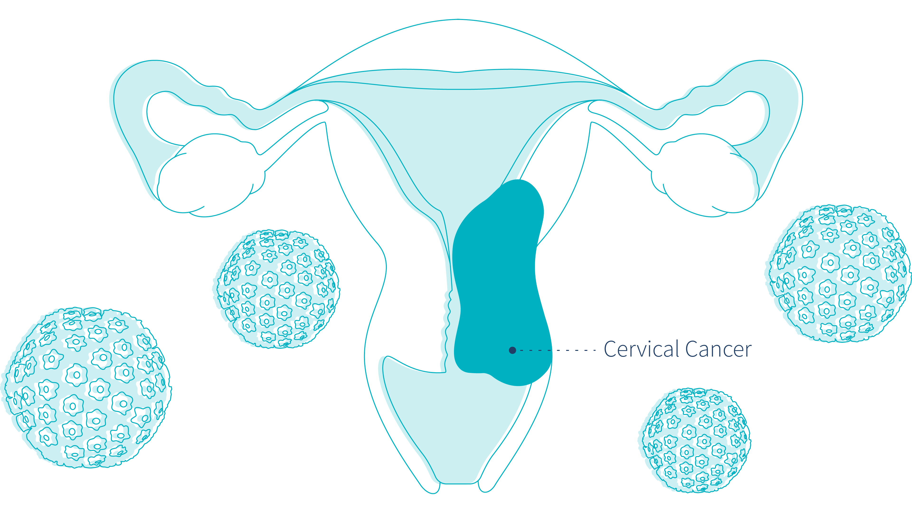 what-causes-cervical-cancer-letsgetchecked-illustration-of-hpv-and-cervical-cancer