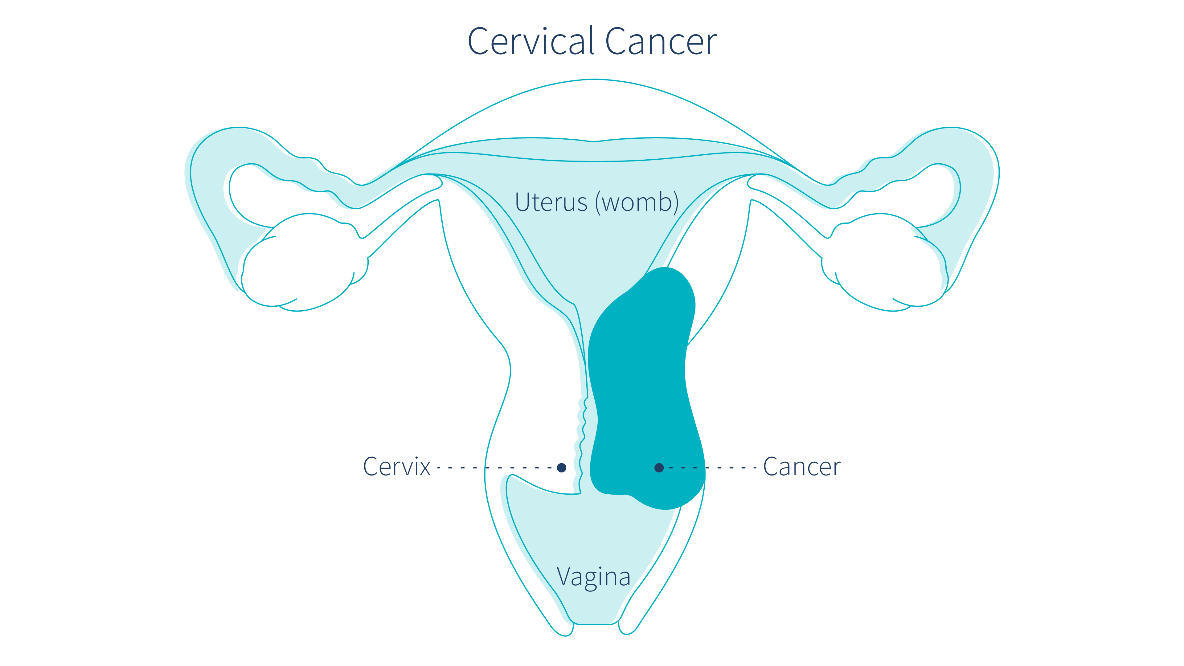 what-part-of-the-body-does-cervical-cancer-affect-letsgetchecked-illustration