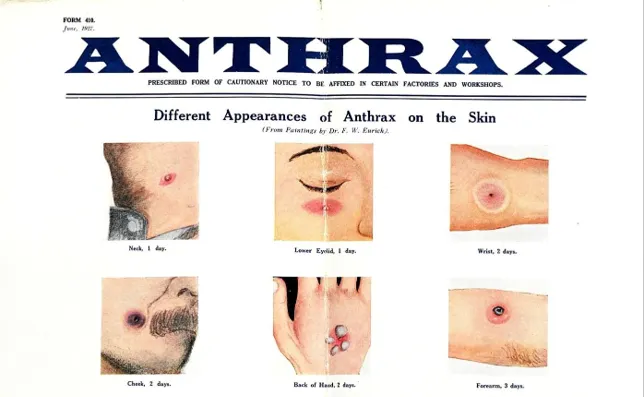 Workers kept dying of "la maladie de Bradford". It was anthrax.