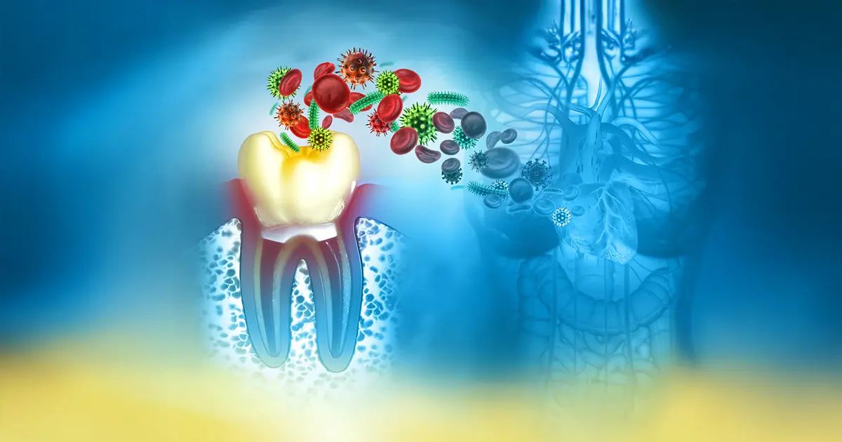 잇몸 질환 세균은 심방세동 위험 증가와 관련이 있다