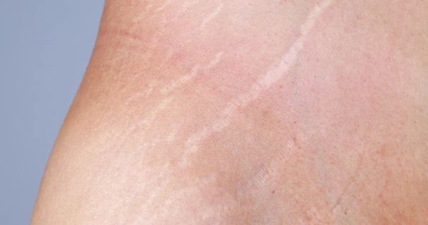 자연스럽게 튼살을 없애는 방법