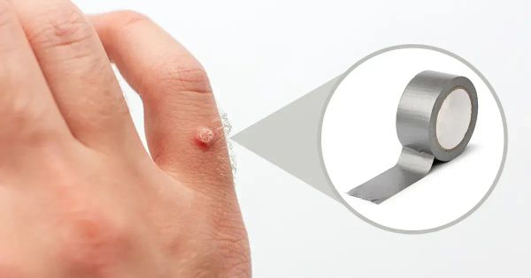 덕트 테이프로 사마귀를 없앨 수 있을까요?