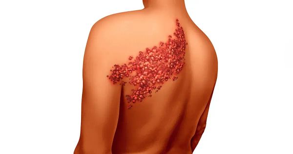 헤르페스와 대상포진을 구별하는 방법