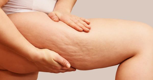 셀룰라이트의 원인은 무엇이고 어떤 방법으로 제거할 수 있을까?