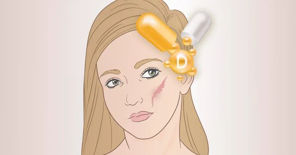 상처와 켈로이드 치료에 도움이 되는 비타민 D 경로 조절