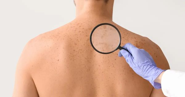 주근깨, 검버섯, 점을 구별하는 방법