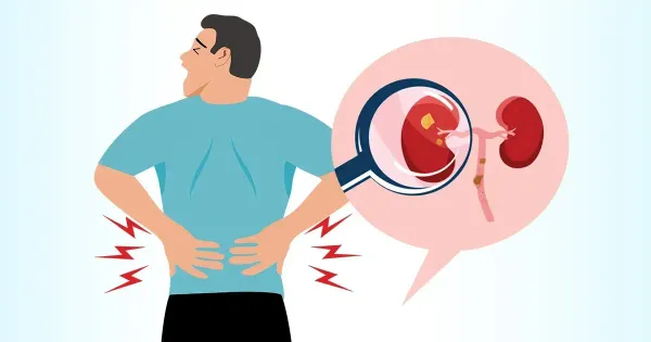 낮은 테스토스테론 수치가 신장 결석 위험을 높이는 숨겨진 원인일 수 있을까?