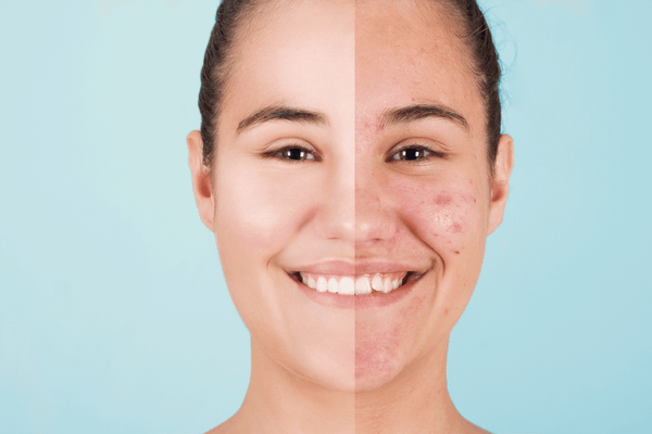 Flawless and Fearless Picks: Top 7 Best Makeup For Acne Prone Skin