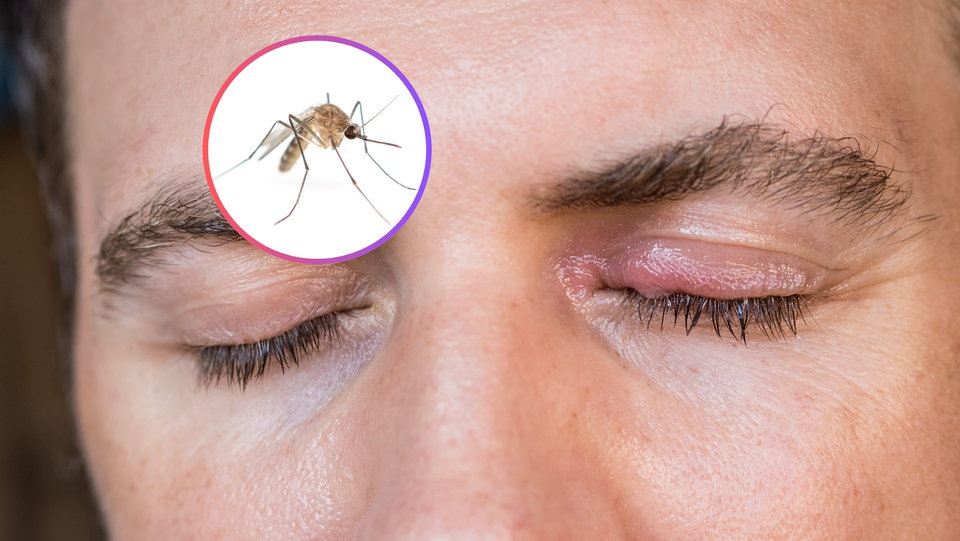 Punture di insetti intorno agli occhi: cosa fare subito?
