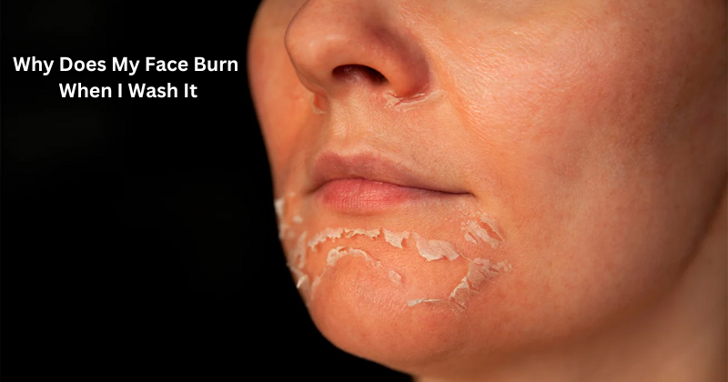Why Does My Face Burn When I Wash It