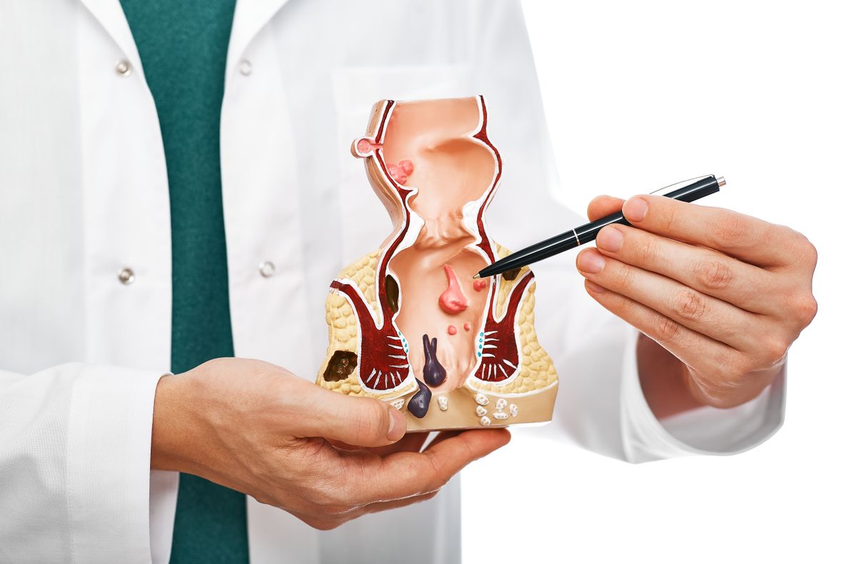 【大腸癌】有何先兆？整合早期症狀、原因、篩檢及治療方法！